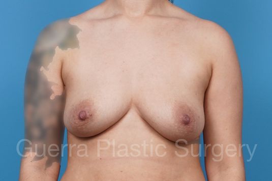 next Case #39495 Before