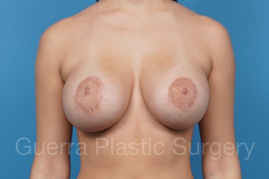 next Case #39456 After