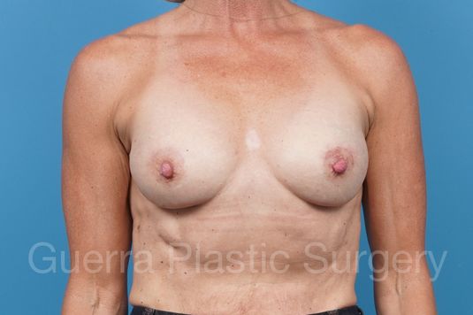 next Case #42871 After