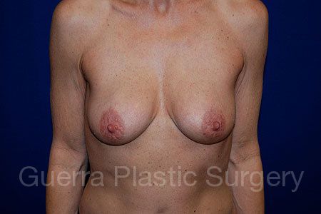 Case #28433 Before