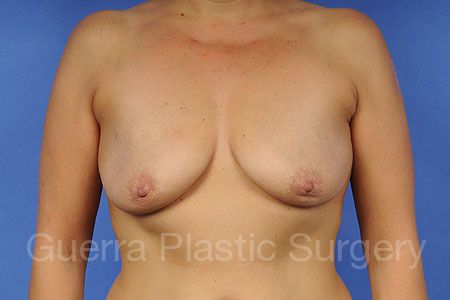 prev Case #55488 Before
