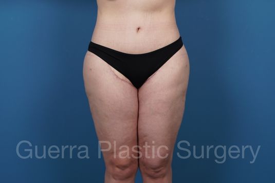 next Case #33954 After