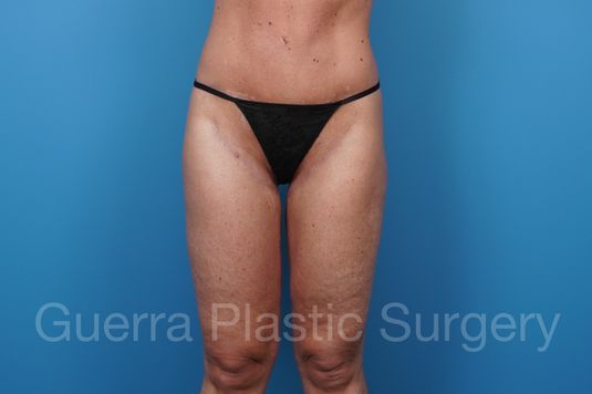 prev Case #32882 After