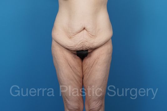 prev Case #38727 Before