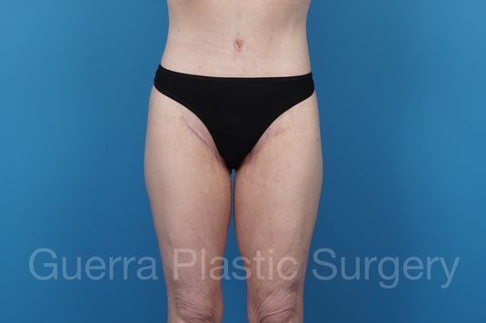 prev Case #38727 After