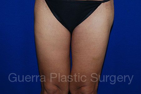 next Case #3886 After