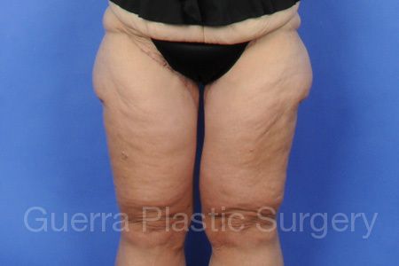 Case #4717 After