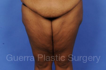 Case #7267 Before