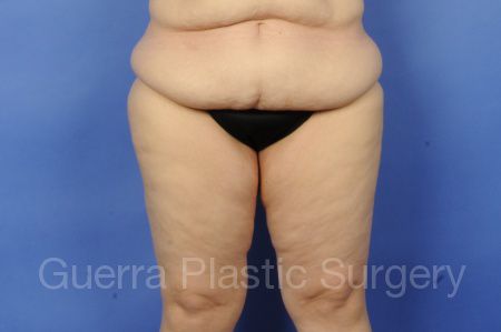 Case #11810 Before