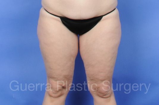 Case #11069 Before