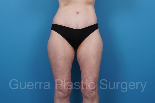 next Case #39777 After