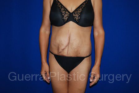 prev Case #32511 After