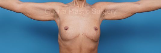 Case #36370 Before