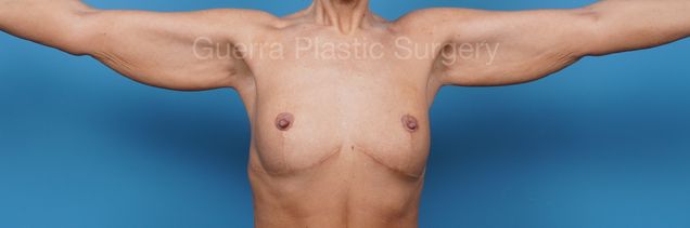 Before Photo Arm Lift