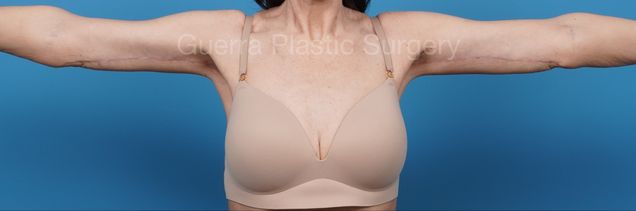After Photo Arm Lift