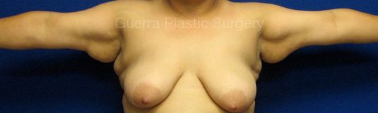 Case #10025 Before