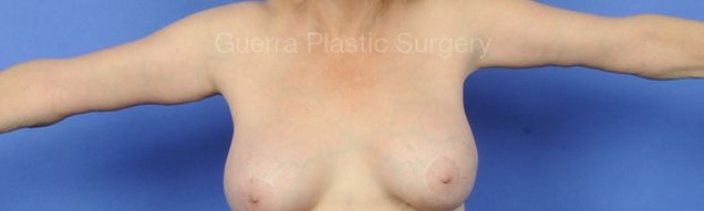 prev Case #13009 After