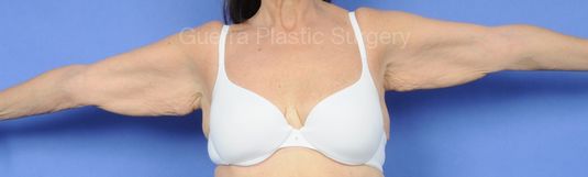 Case #30917 Before