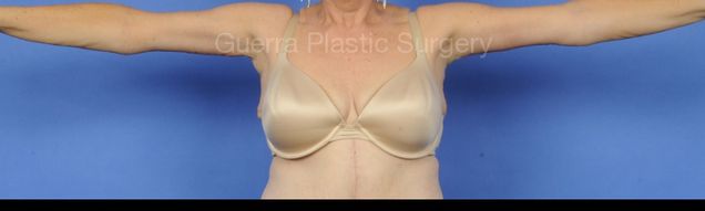 prev Case #13010 After