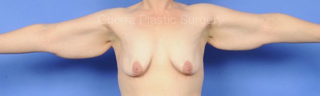 next Case #13011 Before