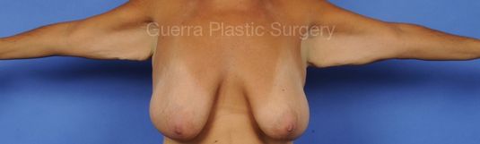 Case #87956 Before