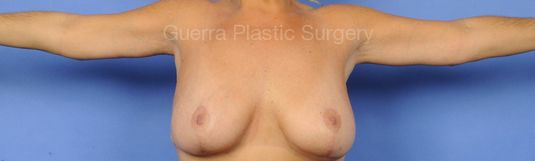 Case #87956 After