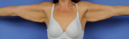 Case #17849 Before