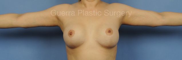 prev Case #03035 After