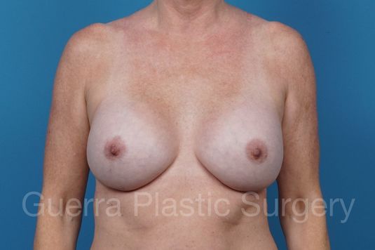 Case #36566 After