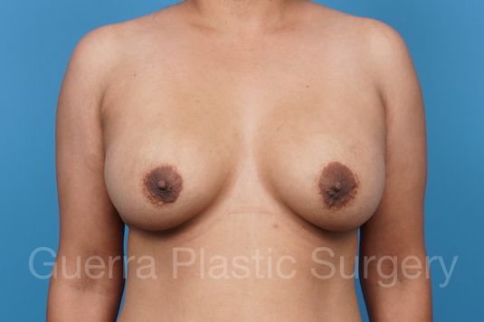 Before Photo Breast Implant Exchange