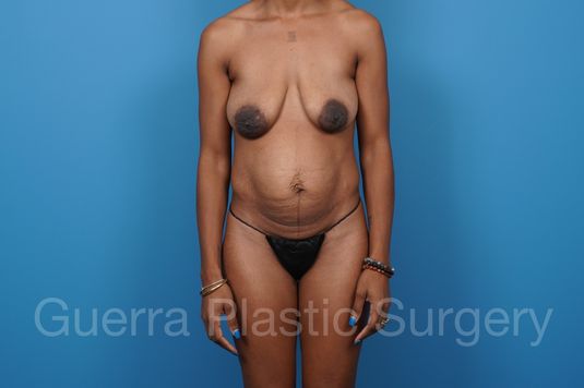 Before Photo Tummy Tuck with Breast Lift / Implant