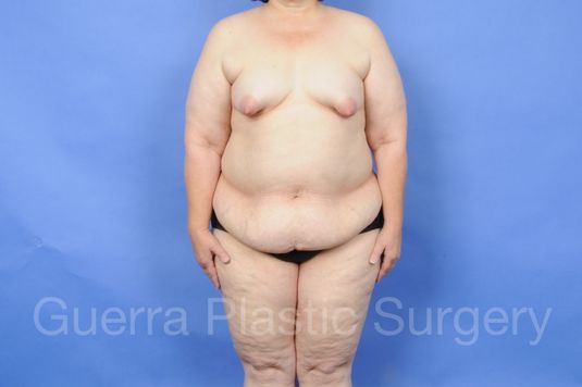 Case #28077 Before