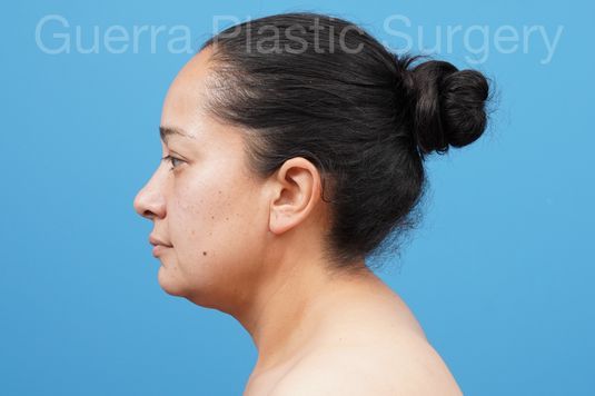Neck Liposuction - Case #44763 After
