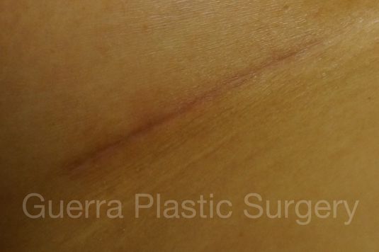 prev Case #4106 After