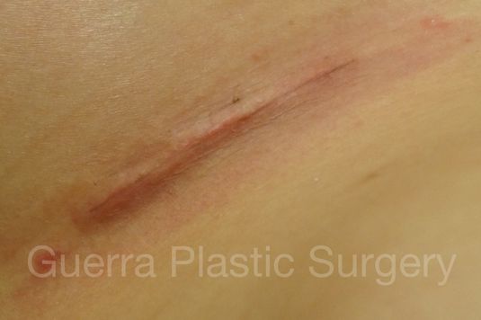 next Case #4109 Before