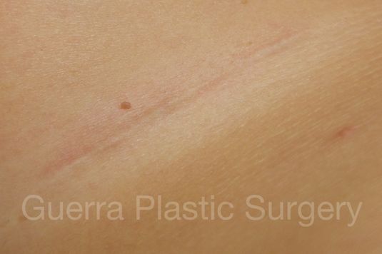 next Case #4109 After
