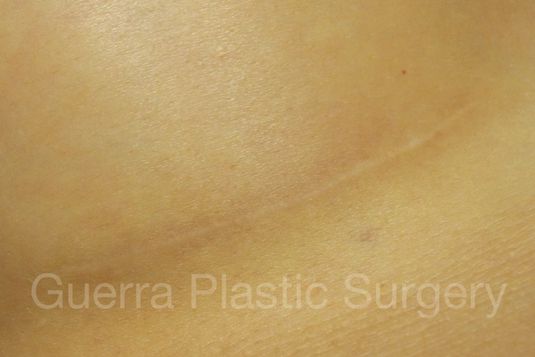 prev Case #4110 After