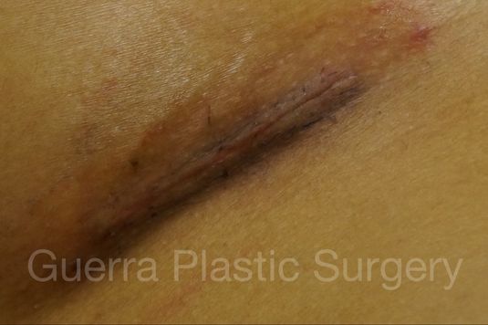 next Case #4111 Before