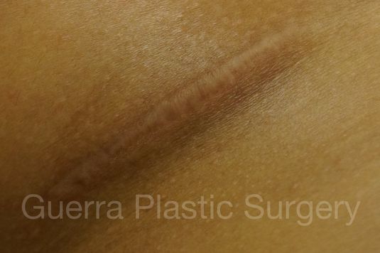 next Case #4111 After