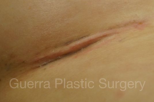 Case #4103 Before