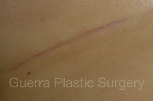 Case #4103 After