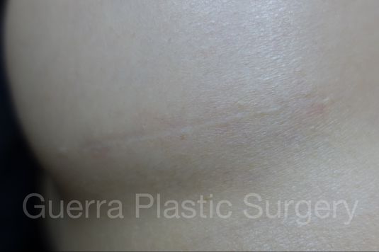 prev Case #4116 After