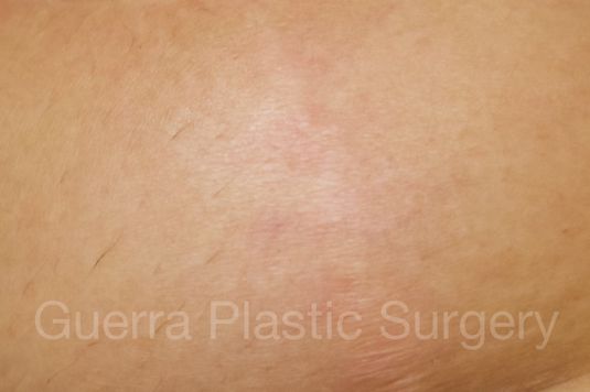 prev Case #4001 After