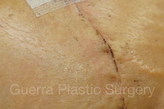 next Case #4003 Before