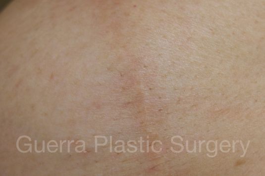 next Case #4003 After