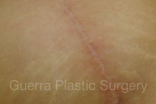 prev Case #0404 After