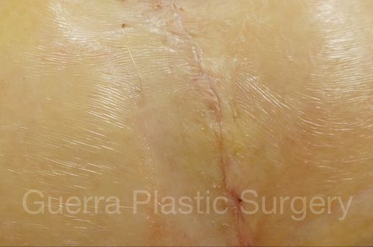 next Case #0405 Before