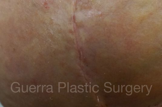 next Case #4006 Before