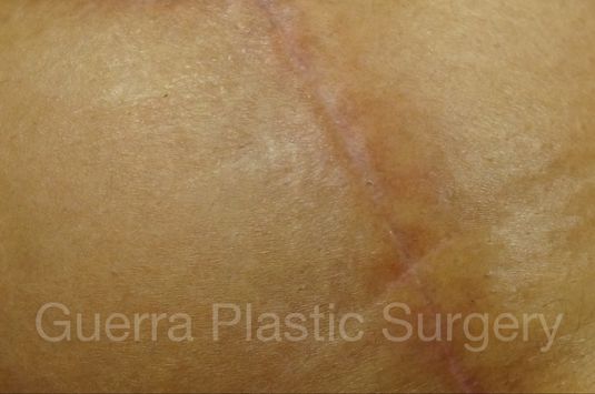 next Case #4009 Before