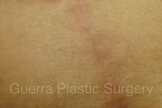 next Case #4009 After